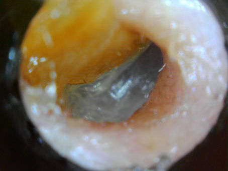 Skin blockage......